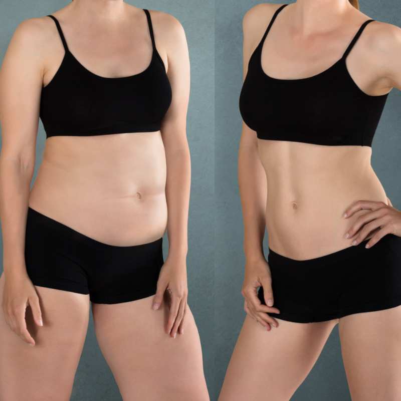 Does Fat Freezing at Home Work? DIY Devices vs Professional Cryolipolysis 2 before and after Cryolipolysis East Tilbury