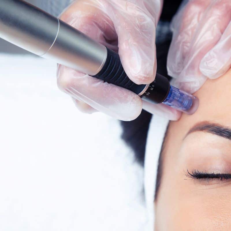 Morpheus8 treatment East Tilbury from Lipo Sculpt - Book in today!